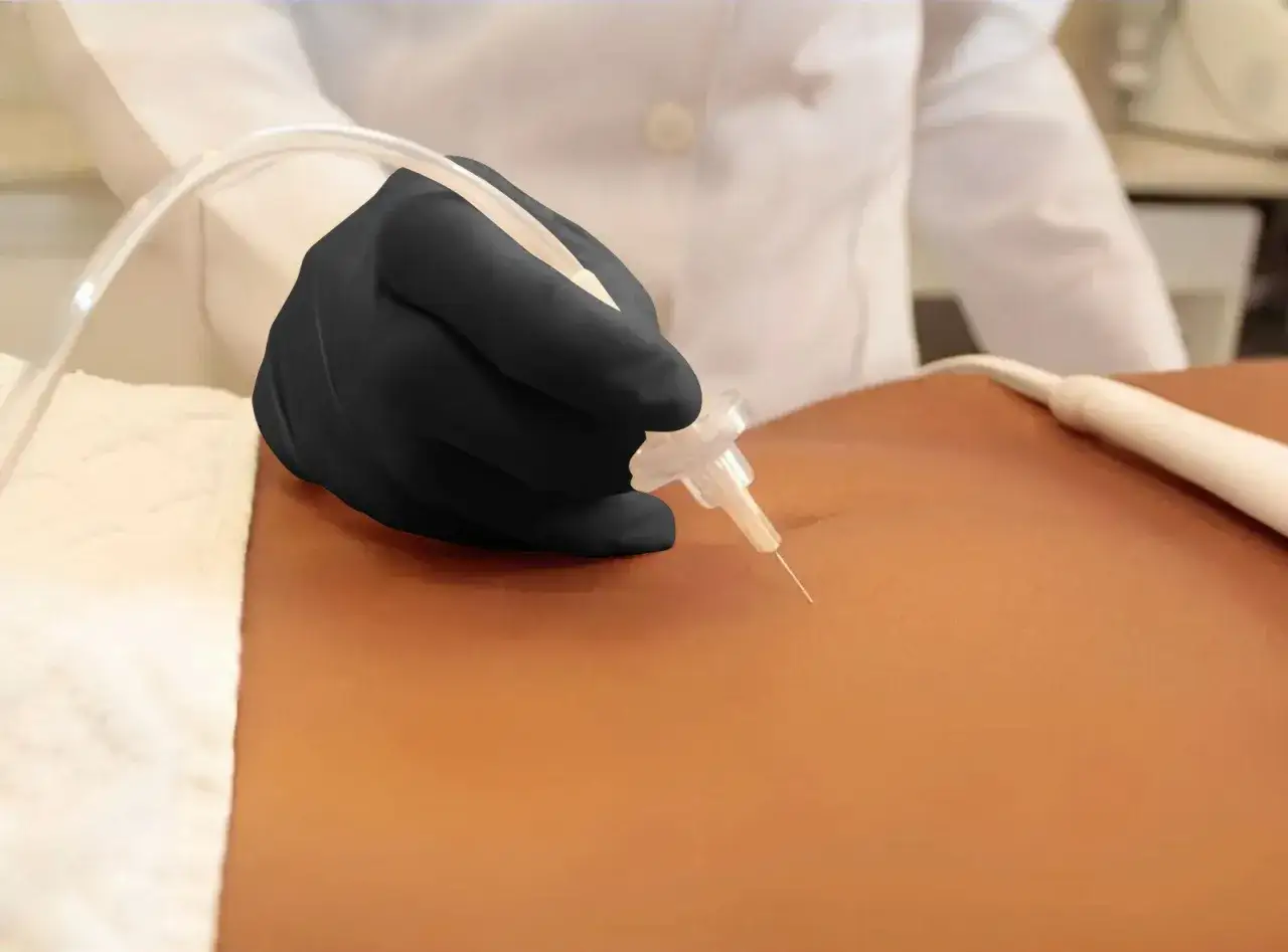 Manos enguantadas realizan carboxiterapia corporal, inyectando dióxido de carbono para mejorar la piel.