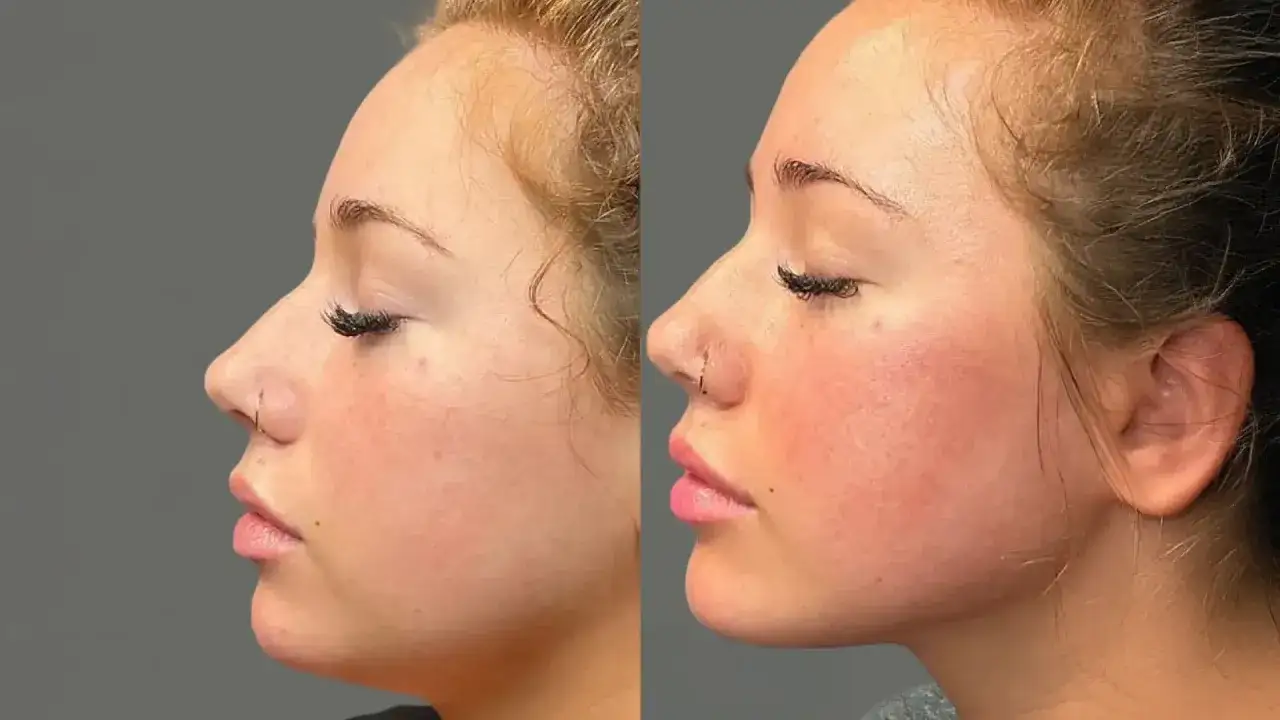 Perfil de una mujer mostrando un cambio en su &oacute;valo facial, con labios m&aacute;s definidos y p&oacute;mulos realzados.