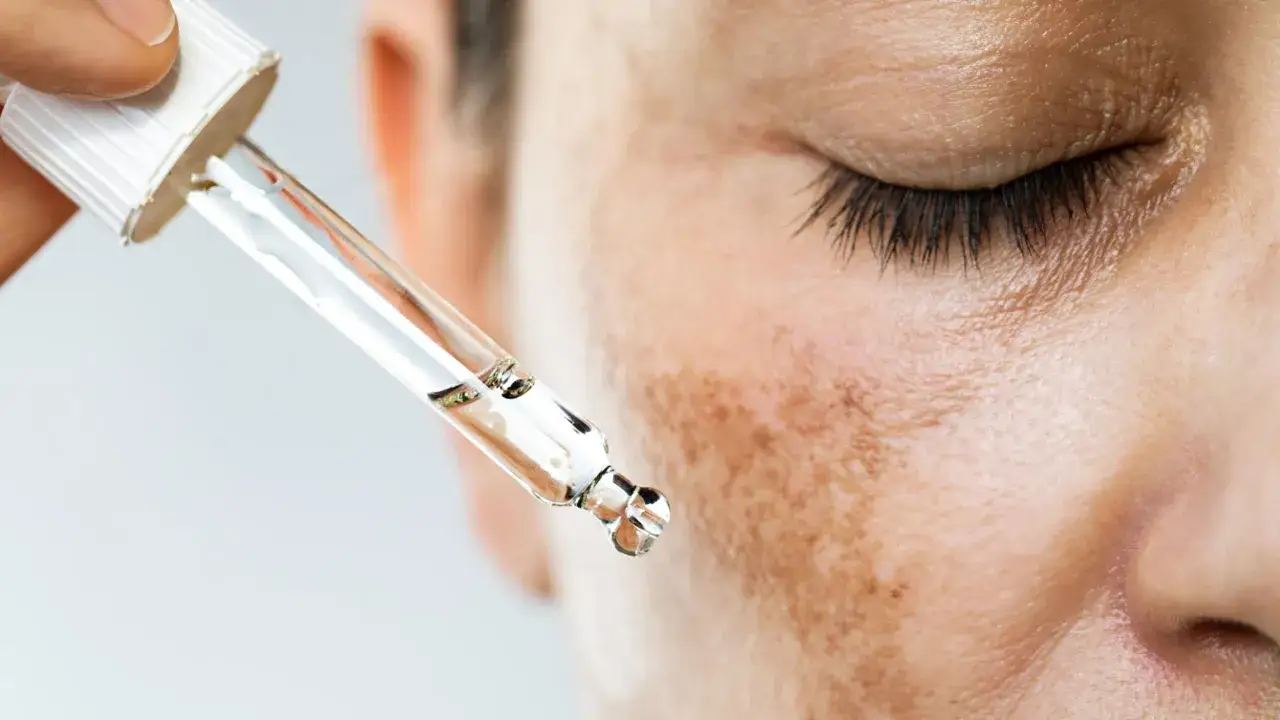Gotas de un suero para quitar melasma caen sobre piel con manchas.