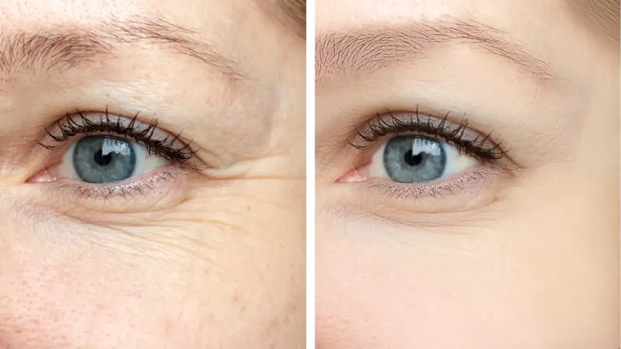 Comparación de piel: antes con arrugas debajo de los ojos y después con piel más lisa y rejuvenecida.