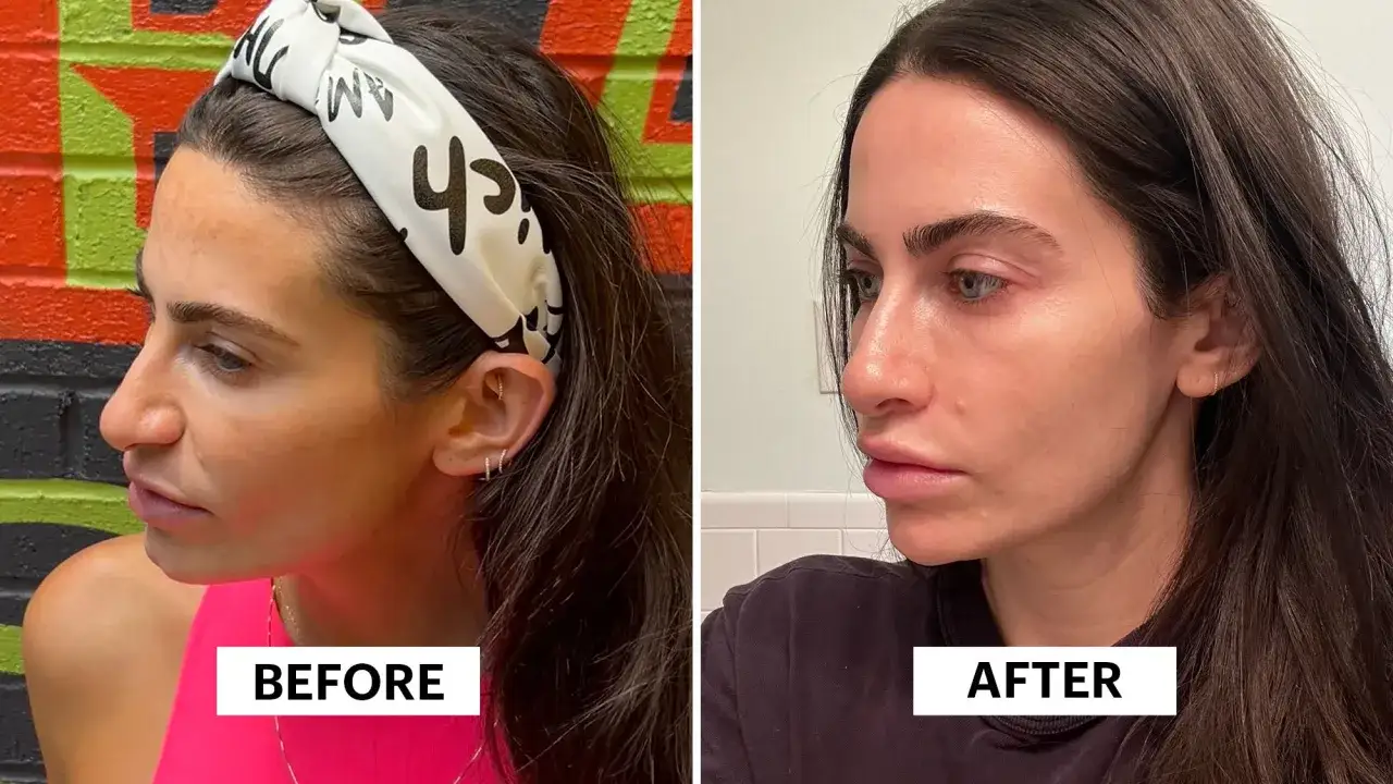 Antes y después de usar ácido tranexámico para mejorar la pigmentación de la piel.