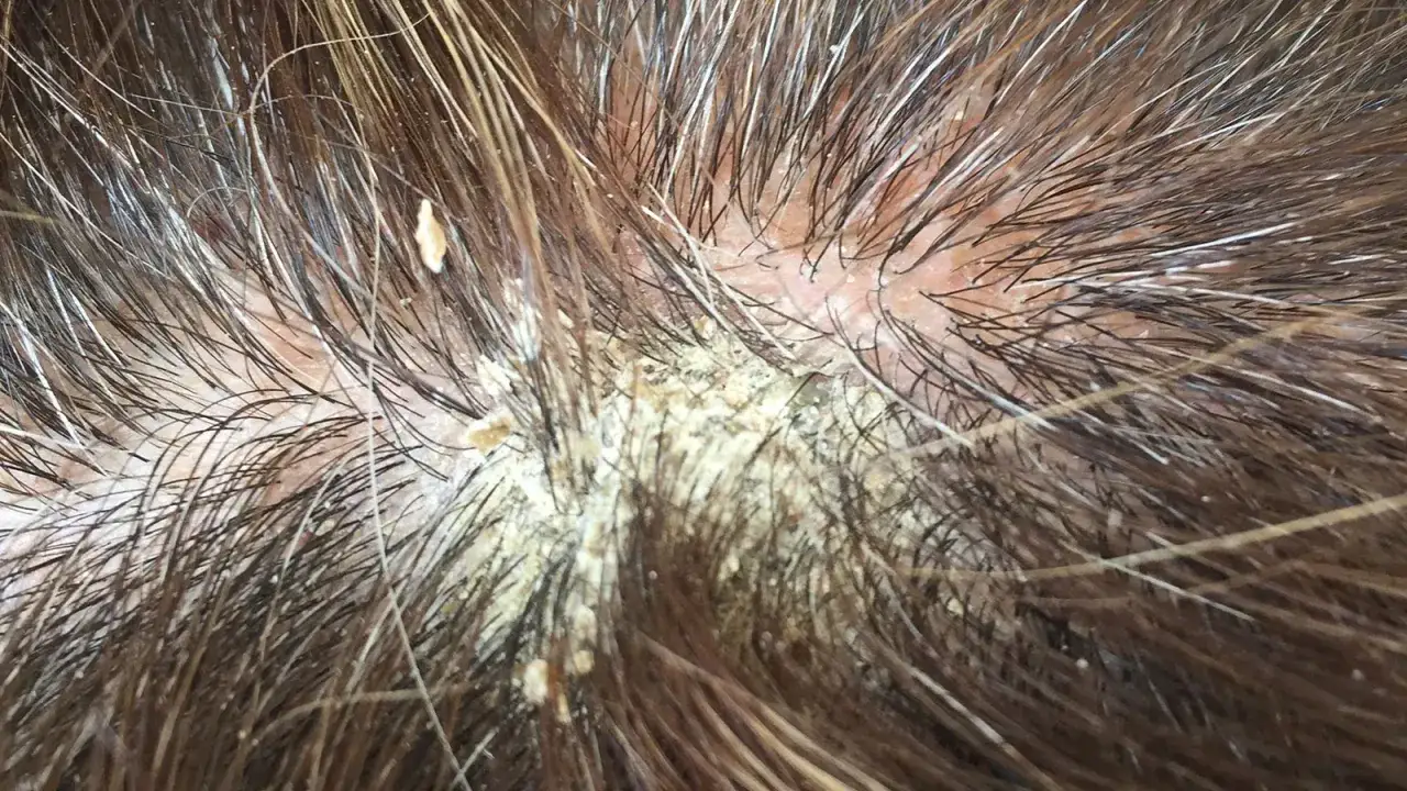 Cuero cabelludo con descamaci&oacute;n amarillenta y cabello oscuro. Podr&iacute;a ser un caso que necesite vital plus fs.