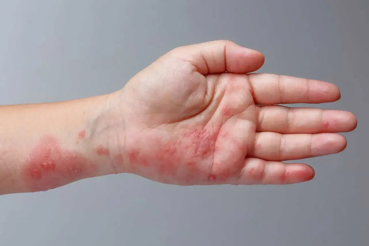 Mano con manchas rojas y erupciones, indicando posible irritaci&oacute;n o alergia.