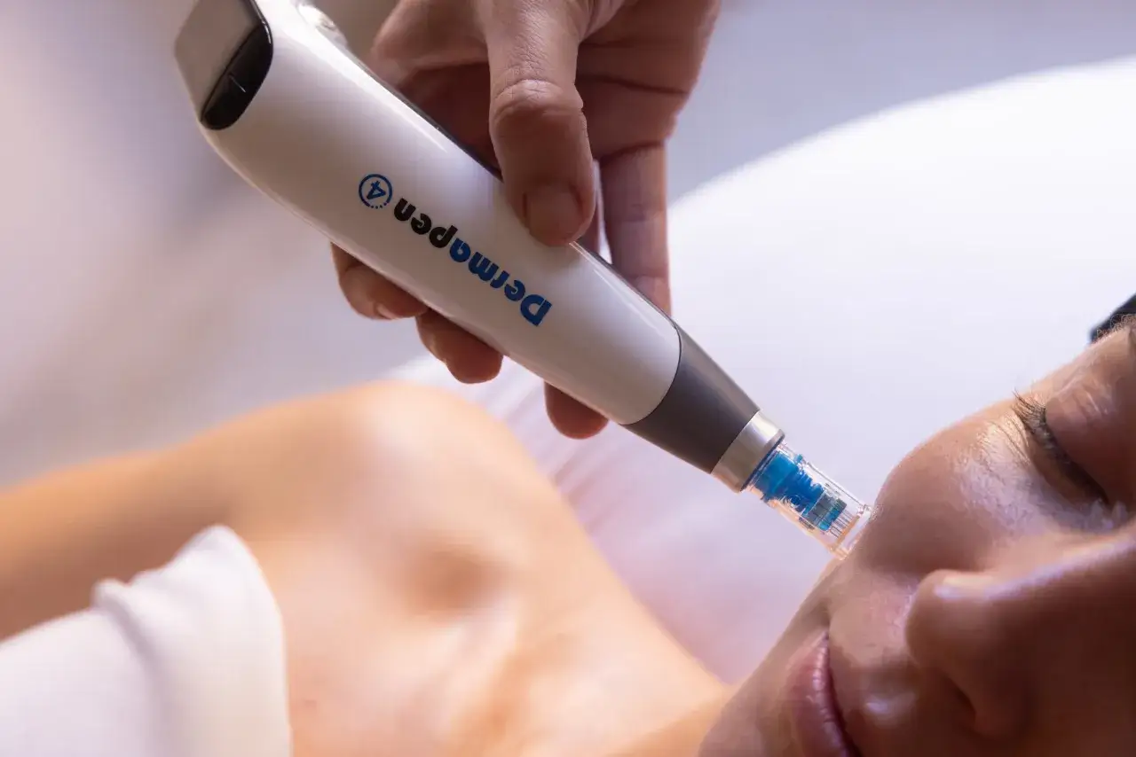 Un Dermapen realiza un tratamiento de microneedling facial, creando microcanales para mejorar la piel.