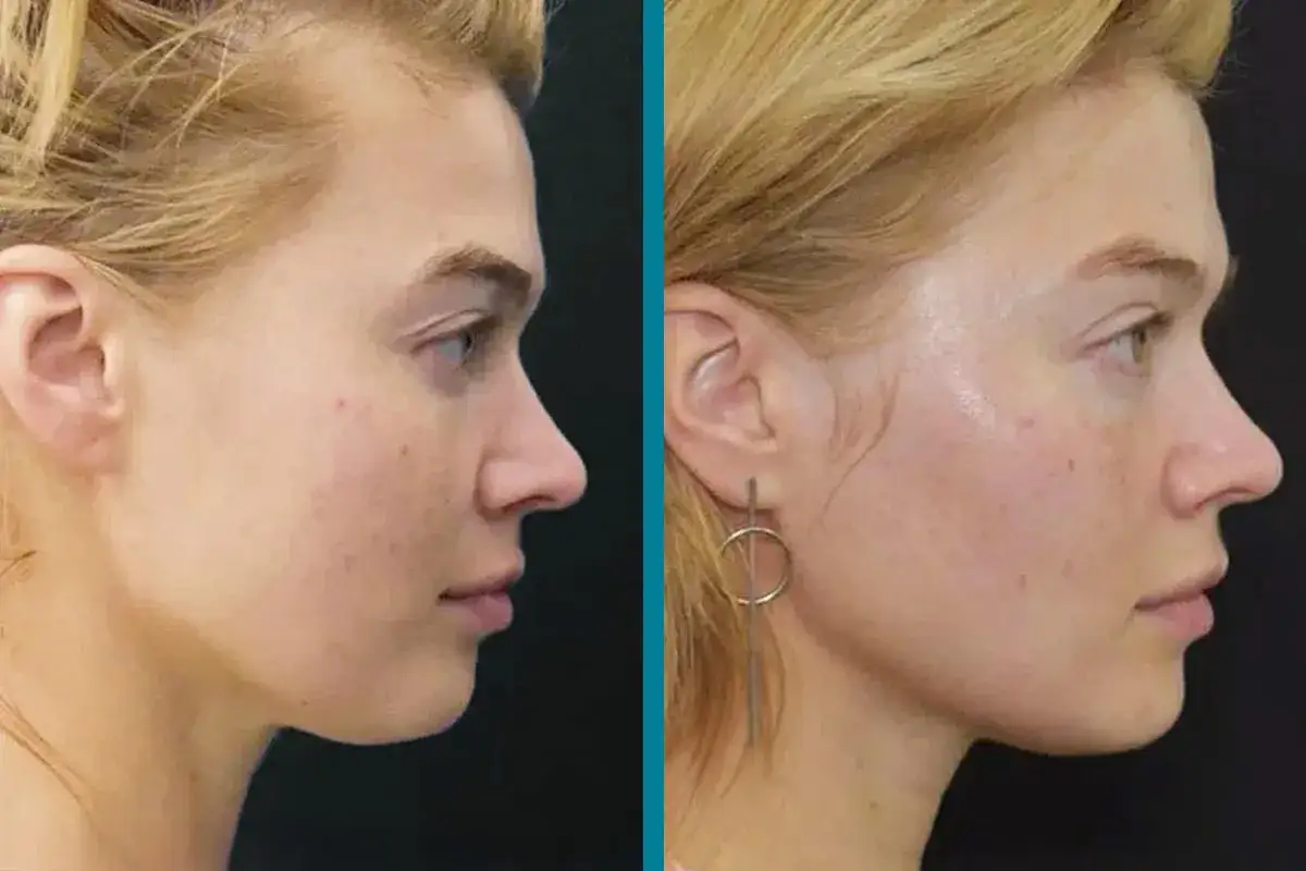 Comparativa de radiofrecuencia facial antes y despu&eacute;s: piel m&aacute;s firme y luminosa.