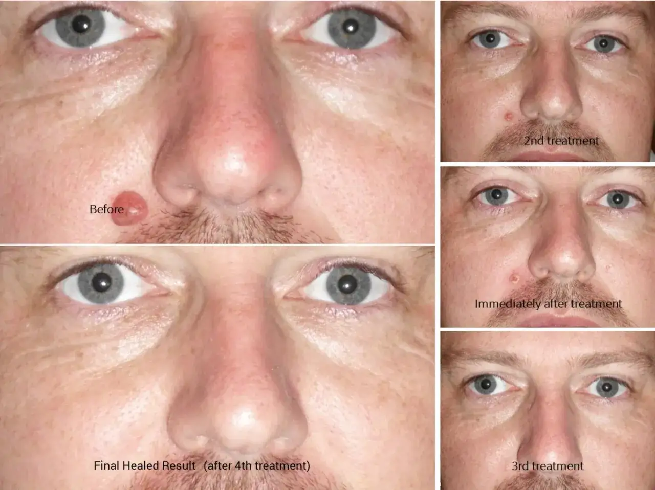 Diatermia facial antes y después: un hombre muestra una lesión cutánea antes del tratamiento, su evolución tras varias sesiones y el resultado final curado.