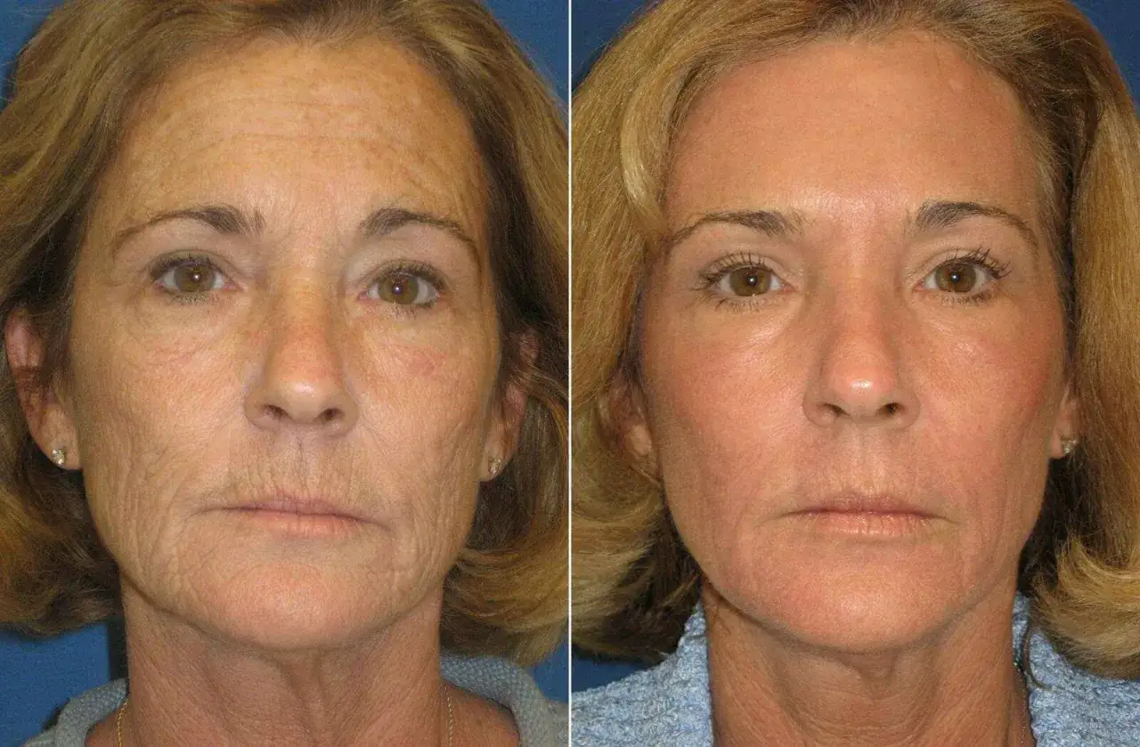 Comparaci&oacute;n antes y despu&eacute;s de carboxiterapia facial. La piel luce m&aacute;s tersa y rejuvenecida.