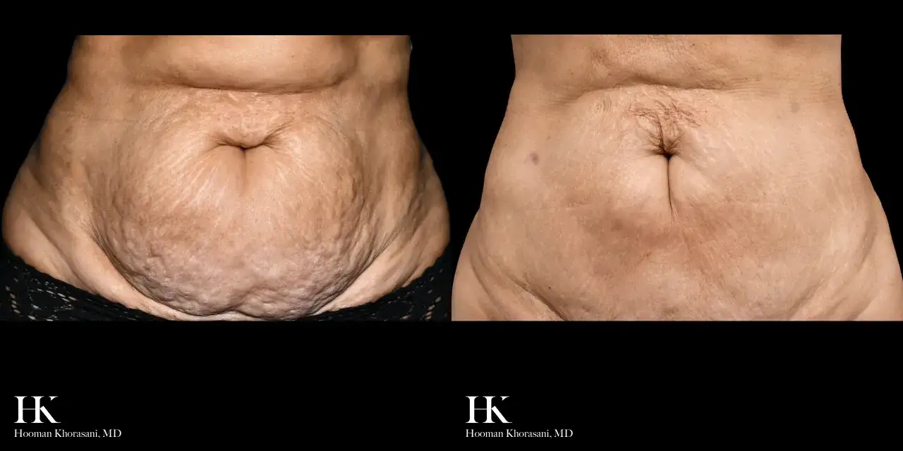 Abdomen antes y después de radiofrecuencia, mostrando mejora en la flacidez y textura de la piel.