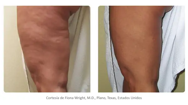 Comparación de radiofrecuencia corporal antes y después: pierna con celulitis visible antes, y pierna con piel más lisa y firme después.