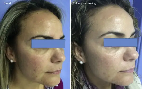 Comparación antes y después de un peeling para manchas. La piel luce más uniforme y luminosa tras el tratamiento.