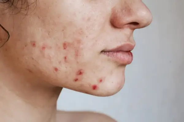 Primer plano de una mejilla con acné inflamado, mostrando la búsqueda de cómo quitar el acné.
