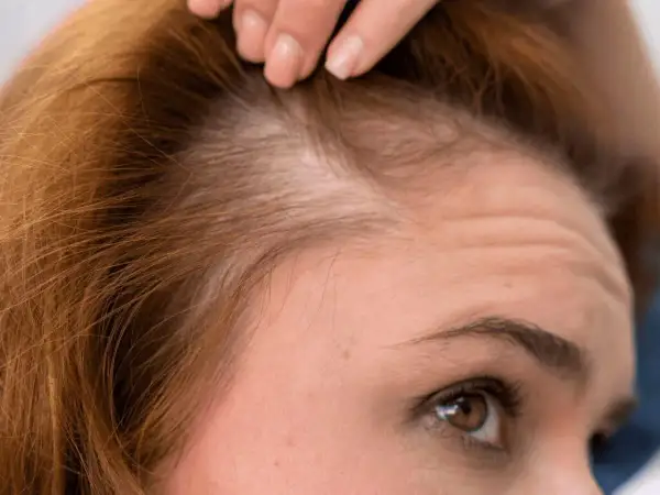 Primer plano de una mujer examinando su cuero cabelludo, preocupada por la caida de pelo.