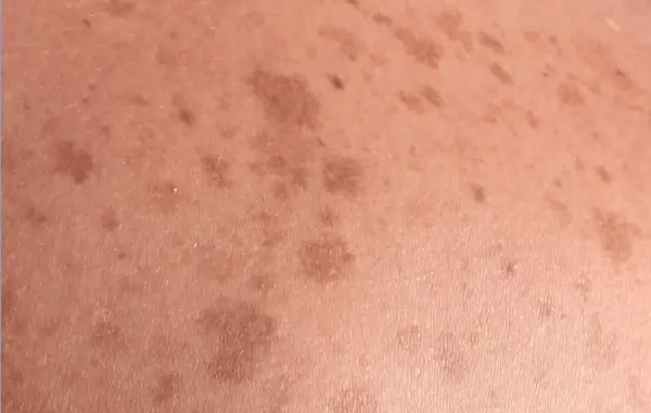 Piel con manchas marrones irregulares, indicativas de lentigo solar, resultado de la exposición al sol.