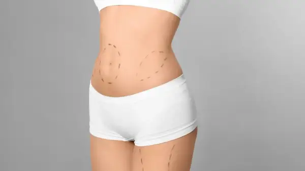 Marcas en el abdomen para tratamiento de radiofrecuencia.