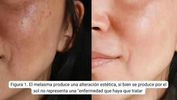 Comparativa de piel con melasma y piel tratada. Buscando amchafibrin para manchas opiniones, se observa mejora.