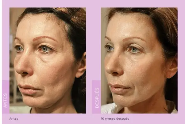 Comparativa de radiofrecuencia facial antes y después. La piel luce más firme y tersa, con menos arrugas y líneas de expresión.