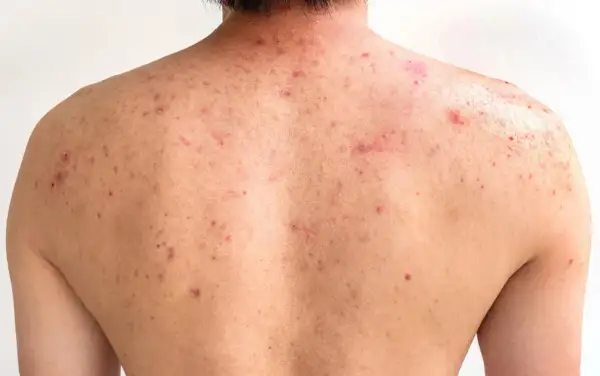 Espalda con numerosos granos y marcas de acné, mostrando rojeces e inflamación.