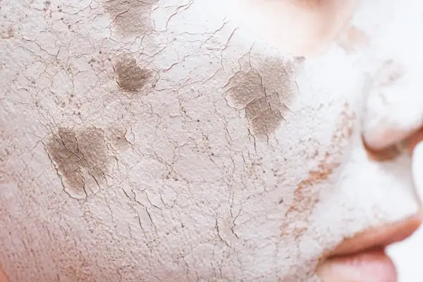Primer facial agrietado y seco, con parches oscuros, que simula una barrera cutánea dañada.