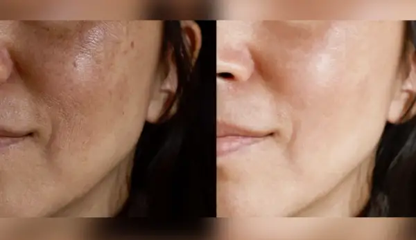 Comparación de piel: antes con melasma en la cara y después con piel más uniforme y luminosa.