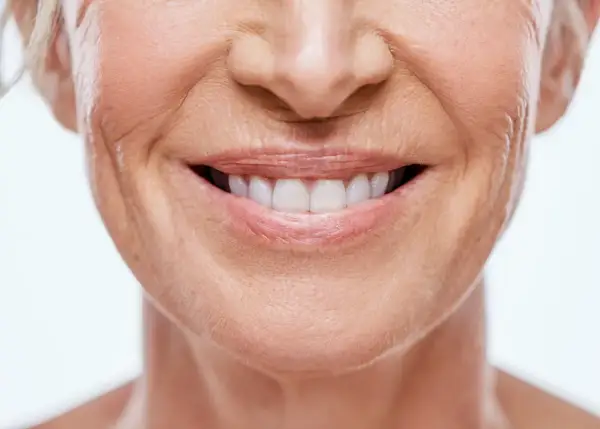 Sonrisa radiante con surco nasogeniano antes y después. Piel tersa y rejuvenecida.
